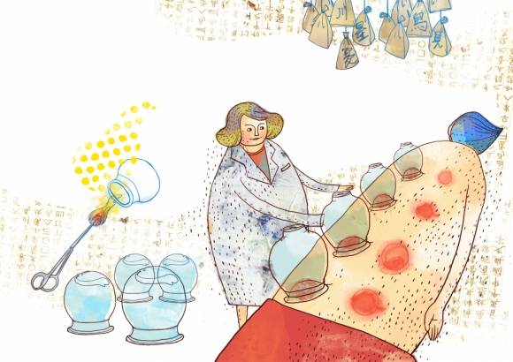 부항 치료 이미지. 아이클릭아트