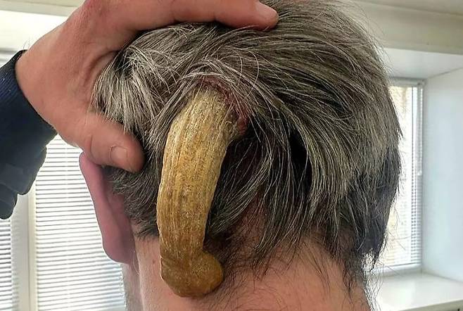 남성 머리에 자라난 뿔. /미러