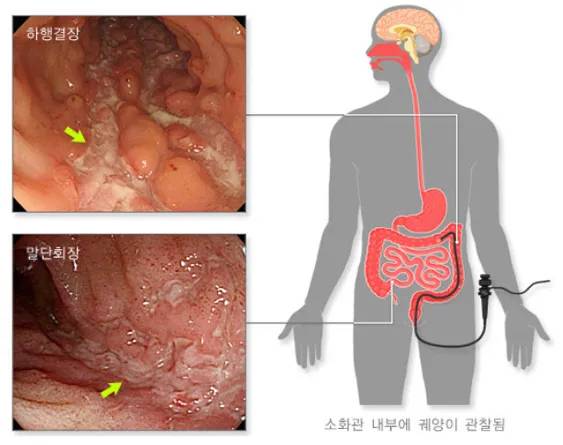 크론병 환자의 대장을 내시경으로 검사하면 궤양이나 농양, 협착, 염증 등이 관찰된다. 보건복지부 제공