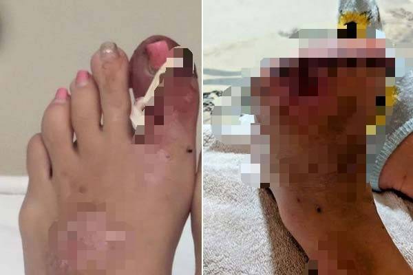 평소 당뇨병을 앓던 레이시 셰드릭(42)은 내성 발톱으로 인한 감염으로 왼쪽 발의 발가락 전체와 일부를 절단했다. 절단 전 레이시 셰드릭의 발(왼쪽)과 절단 후의 발(오른쪽)./사진=더 선