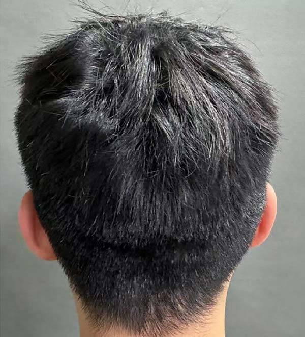 A씨가 수술, 광역학 치료를 받은 후 두피 모낭염이 회복된 모습.​/사진=성형외과 및 재건외과 글로벌 오픈