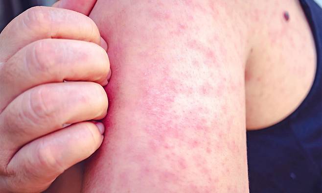 홍역의 대표적인 증상인 붉은 발진. 게티이미지뱅크 제공