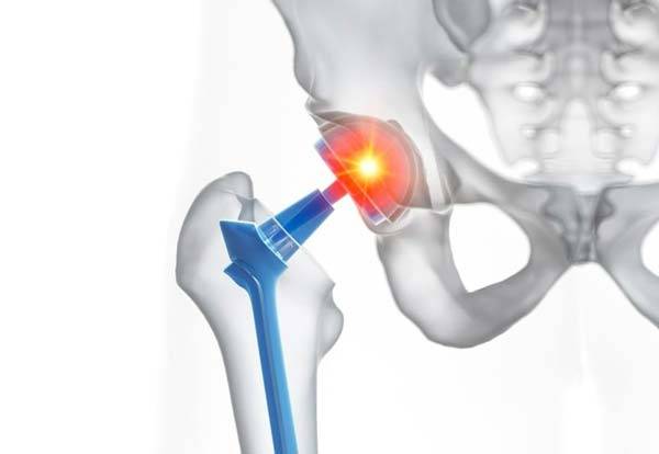 고관절 인공관절./사진=클립아트코리아