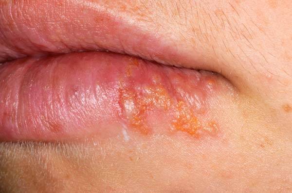 1형 헤르페스 재발을 막으려면, 꾸준한 영양제 섭취와 스트레스를 피하는 게 도움이 된다./사진=클립아트코리아