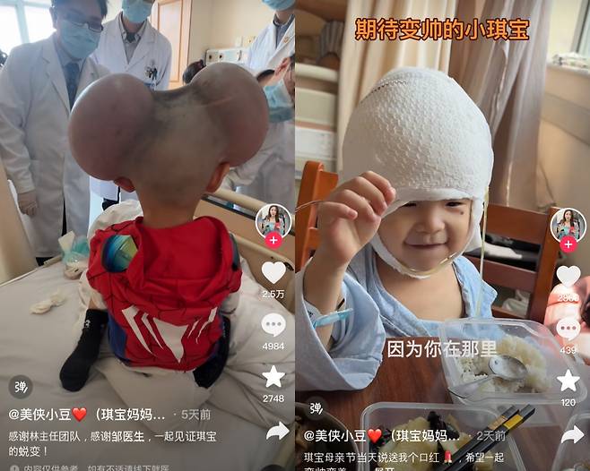 치바오 수술 전후 모습 [치바오 엄마 더우인 캡처]