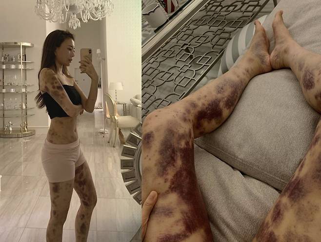 아옳이가 SNS에 올린 피멍 사진. [아옳이 인스타그램 캡처]