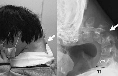 매일 장시간 스마트폰 게임을 한 결과 목이 꺾이는 ‘머리떨굼 증후군’에 걸린 남성의 엑스레이 사진 [이미지 출처=사이언스 다이렉트 캡처]