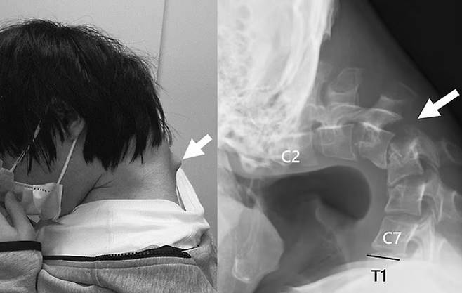 긴 시간 스마트폰 게임을 하다 목뼈가 꺾여 버린 일본 남성 모습. /사진=데일리메일 갈무리