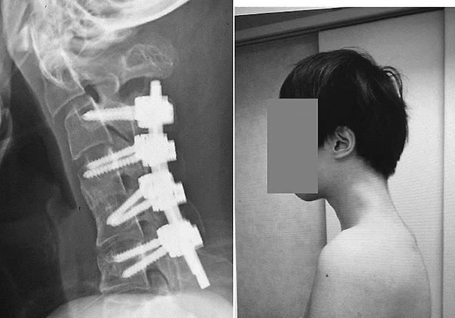 수슬후 다시 펴진 목뼈. /사진=데일리메일 갈무리