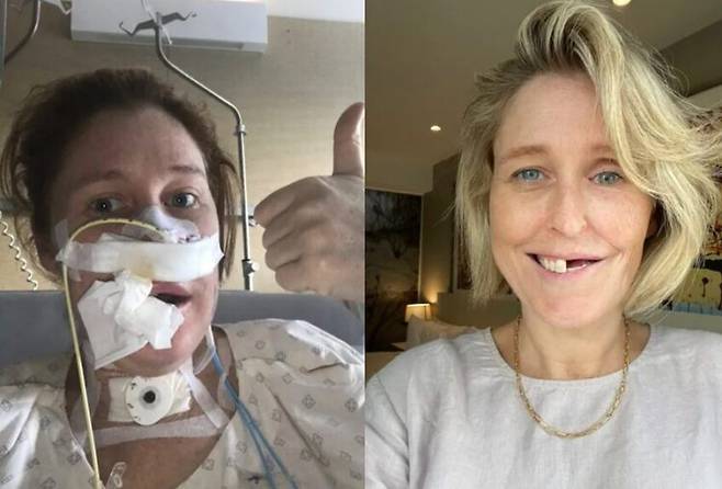 암으로 인해 다리와 발 조직을 이용해 얼굴을 재건한 여성의 사연이 소개됐다. [사진=SNS]