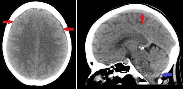 여성의 뇌 양측 경막에 고여 있는 뇌척수액(빨간색 화살표)의 모습과 소뇌 경막에 고여 있는 뇌척수액(파란색 화살표)의 모습)/사진=BMC-Part of Springer Nature