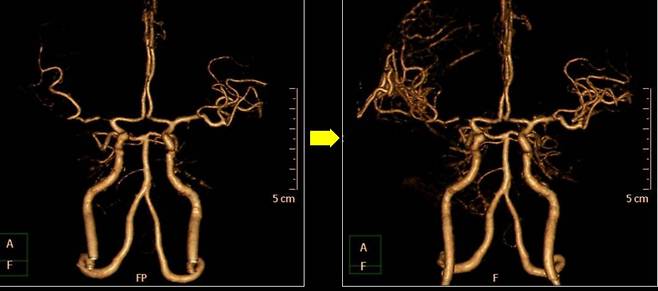 (사진 왼쪽부터) 막힌 뇌 혈관의 '우회로'를 뚫는 뇌혈관 문합술 전과 후 모습. /사진=에스포항병원