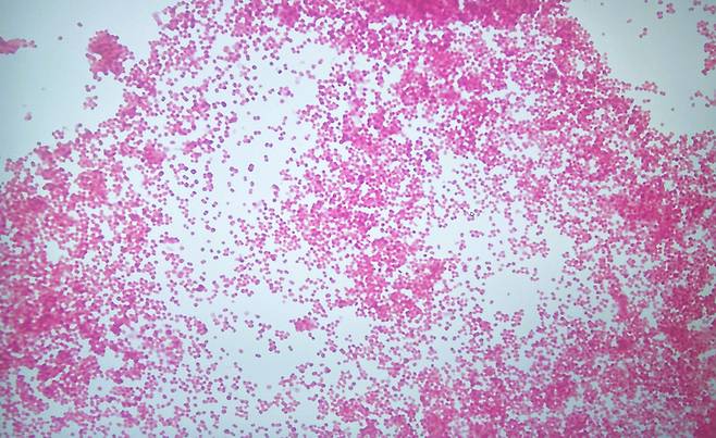 수막구균성 뇌수막염 환자의 뇌척수액 현미경 모습. [게티이미지뱅크]