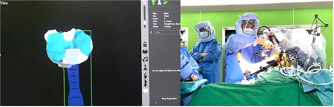 한림대학교강남성심병원 정형외과 김일중 교수가 환자 맞춤 보존형 로봇인공관절수술을 진행하고 있다.