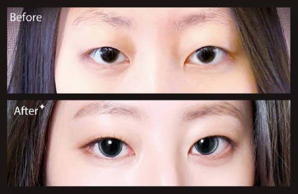 서클렌즈 없이도 눈동자를 또렷하게 보이게 해준다는 ‘아이링 시술’은 결막이 약하거나 망막질환이 있는 사람은 조심해야 한다./사진=압구정연세안과 제공