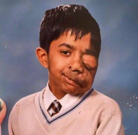 [뉴시스] 그는 선천적으로 '신경섬유종증 1형'이라는 질환을 갖고 태어났다. (사진=BBC) *재판매 및 DB 금지