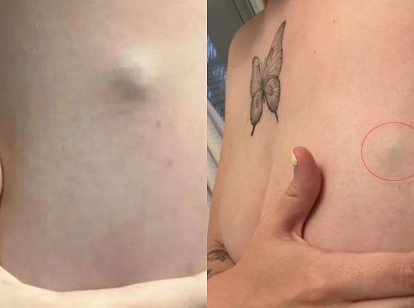 캐나다의 한 20대 여성이 몸 곳곳에 종양이 생긴 후, 피부암 말기를 진단받은 사연이 공개됐다./사진=더 선