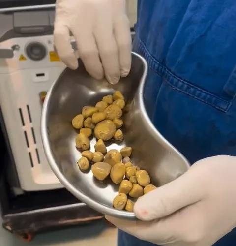 탄산음료를 마시는 습관을 가진 남성의 방광에서 제거된 결석 [사진 출처 = 니드투노우]