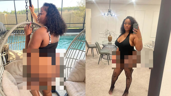 미국의 한 인플루언서가 엉덩이 성형 수술 부작용을 겪고 있다고 밝혔다. [사진 = 더선]