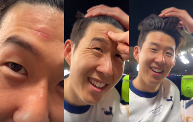 22일 2024-2025 유럽축구연맹(UEFA) 유로파리그에서 우승한 토트넘 손흥민이 이마에 생긴 영광의 상처를 보여주고 있다. 토트넘 공식 SNS