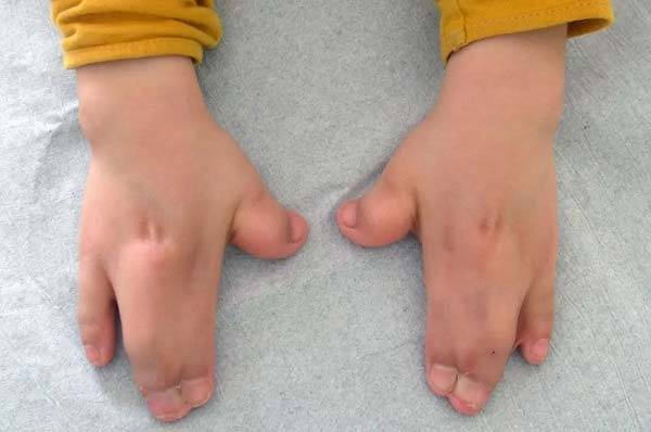 에이퍼트 증후군 때문에 사지 합지증이 나타난 모습​/사진=Medical News Today