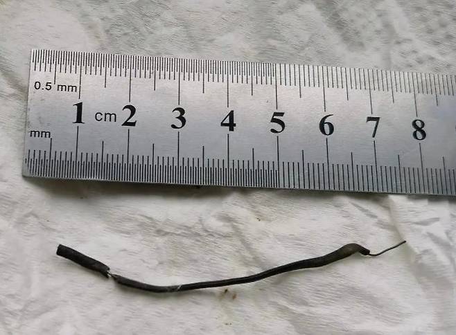 [서울=뉴시스]중국의 한 10세 소년이 하체 통증으로 병원을 찾았다가 몸속에서 7cm 길이의 철사가 발견돼 충격을 주고 있다.(사진=장강일보) *재판매 및 DB 금지