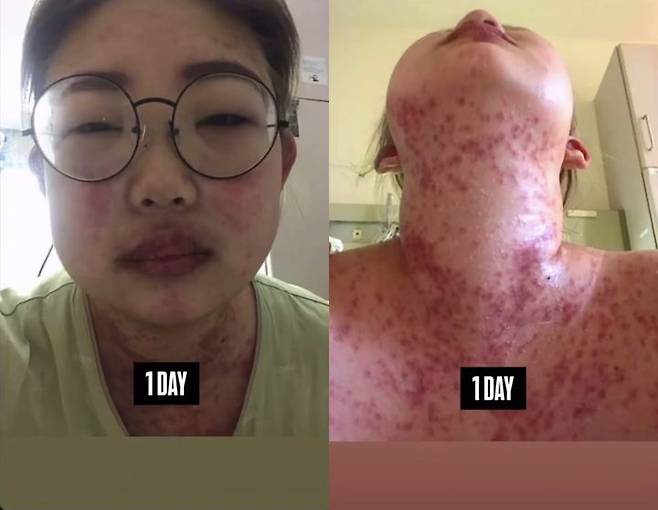 [서울=뉴시스] 최준희가 체중 감량 전 루프스 투병으로 힘들었던 상황을 털어놨다. (사진=최준희 인스타그램 캡처) 2025.05.23. photo@newsis.com *재판매 및 DB 금지