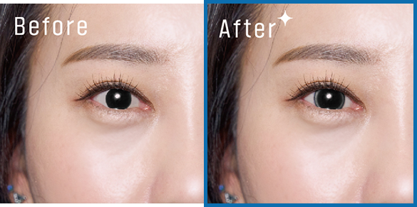 아이링 수술 전후 사진