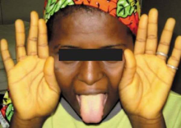 인도의 한 30대 여성이 다이어트 중 특정 음식을 즐겨 먹다가 신체 부위가 노랗게 변하는 증상을 겪은 사연이 공개됐다./사진=인도 피부과학회지