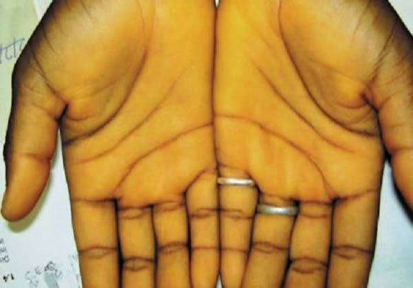 인도의 한 30대 여성이 다이어트 중 특정 음식을 즐겨 먹다가 신체 부위가 노랗게 변하는 증상을 겪은 사연이 공개됐다.​/사진=인도 피부과학회지