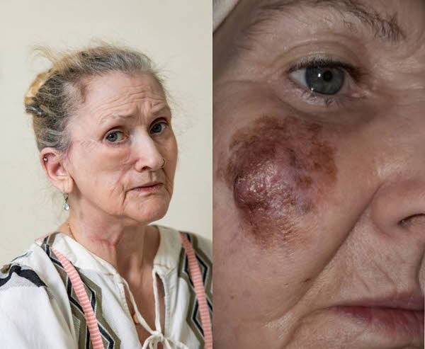 재닛 토마스(63)는 얼굴에 피부암(오른쪽)이 생겨 오른쪽 볼을 제거해야 했다./사진=더 선