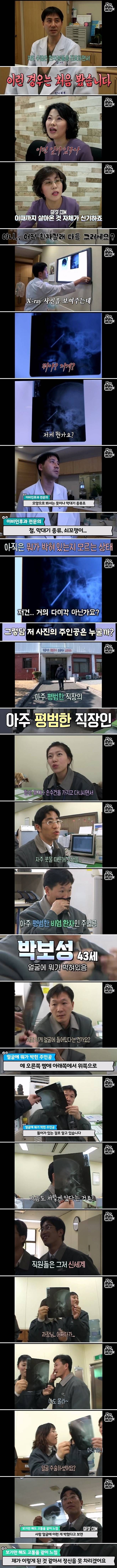 Internet_20240524_032454_1.jpeg 축농증 수술하러 갔다가 얼굴에서 발견한 물건의 정체 축농증 수술하러 갔다가 얼굴에서 젓가락이 나온 사람 ㄷㄷ