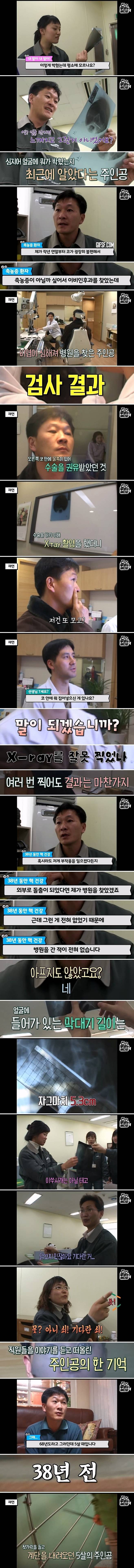 Internet_20240524_032454_2.jpeg 축농증 수술하러 갔다가 얼굴에서 발견한 물건의 정체 축농증 수술하러 갔다가 얼굴에서 젓가락이 나온 사람 ㄷㄷ