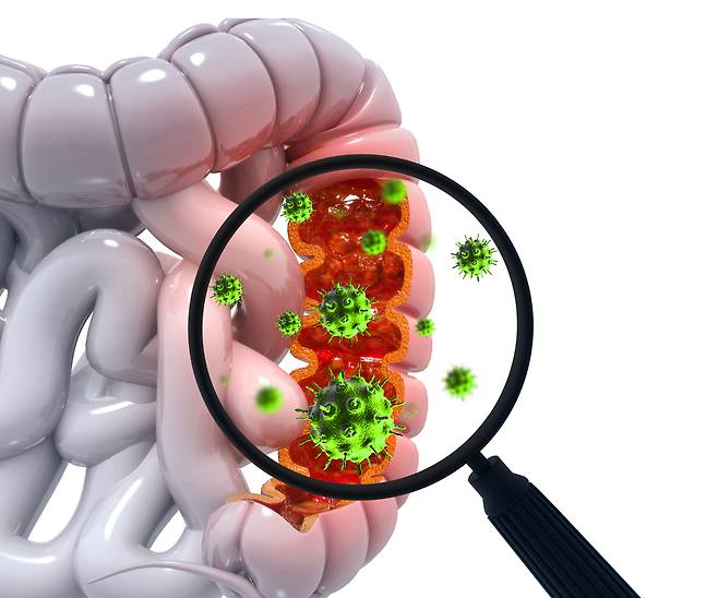 40대 이하 젊은 대장암 환자가 매해 꾸준히 늘며 지난해&nbsp;2만2706명이 발생했다. 게티이미지뱅크