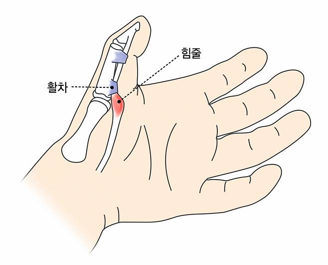 활차가 좁아지거나 힘줄이 두꺼워지면 힘줄이 활차 아래를 통과하기 어려워져 방아쇠 수지가 유발된다. /그림=강동경희대병원