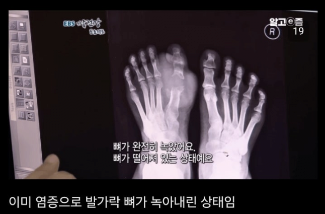 통풍 방치하면 안되는이유