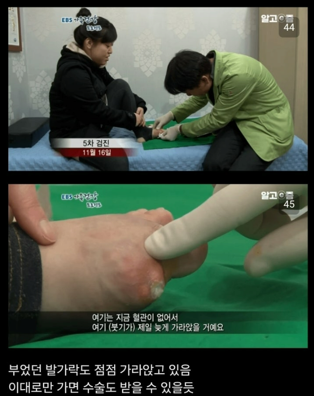 통풍 방치하면 안되는이유