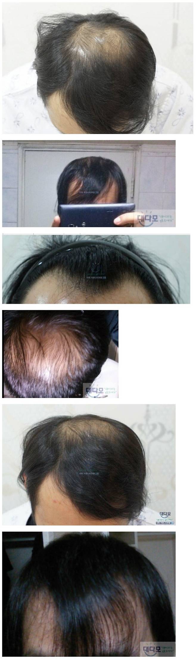 1.jpeg 모발이식에 천만원 투자 한 38살