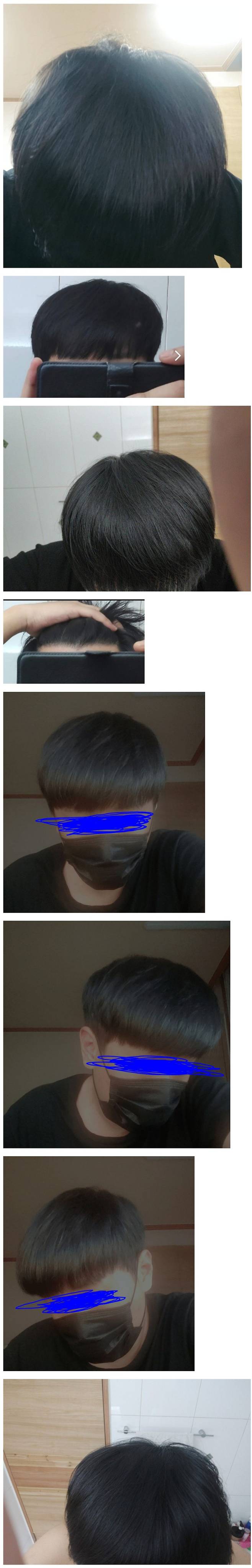 2.jpeg 모발이식에 천만원 투자 한 38살