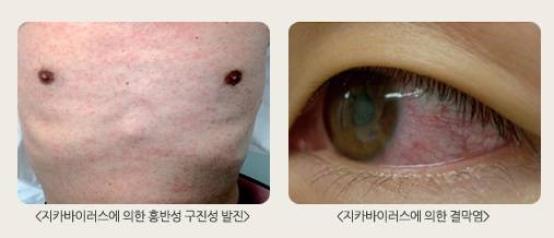 지카바이러스(Zika virus) 감염증 [사진=질병관리청]