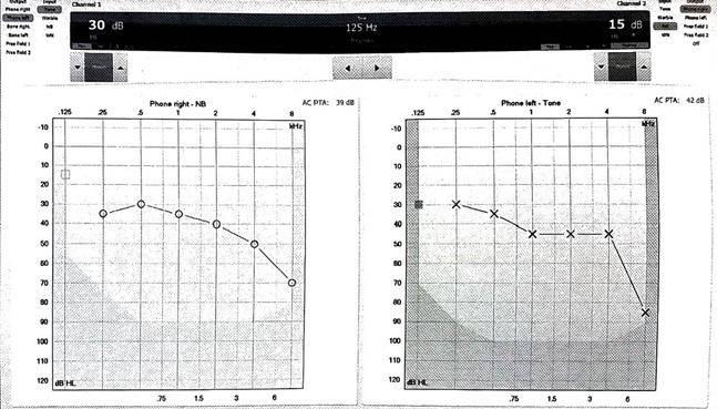 청력 검사한 결과지 ⓒ