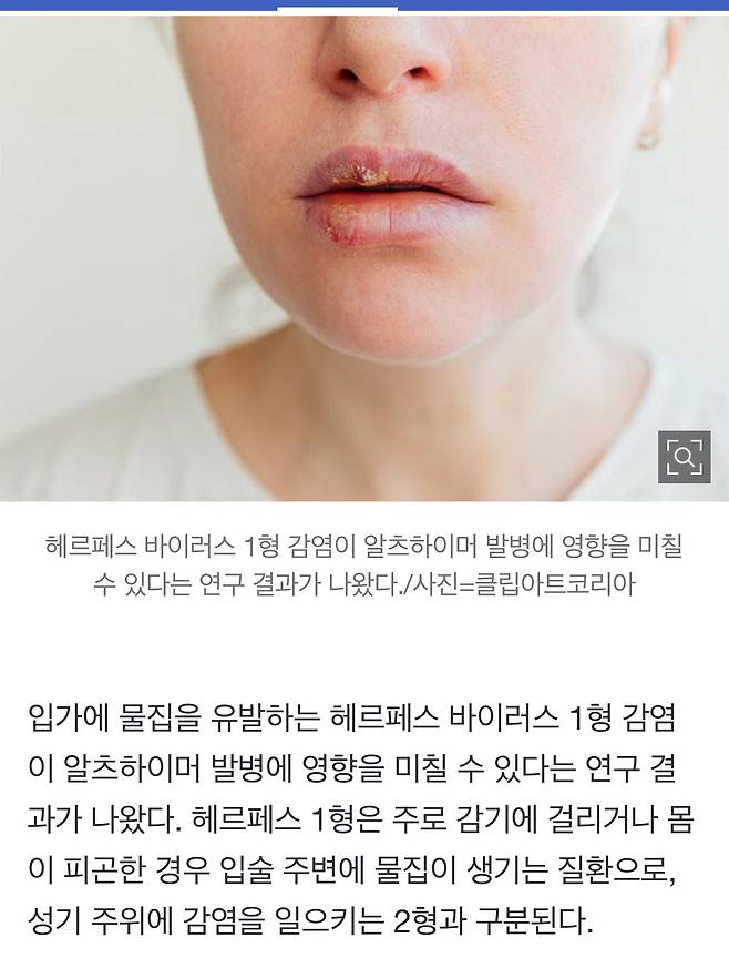 입술 주변 ‘이것’ 자주 생긴다면… 알츠하이머 치매 위험 80%