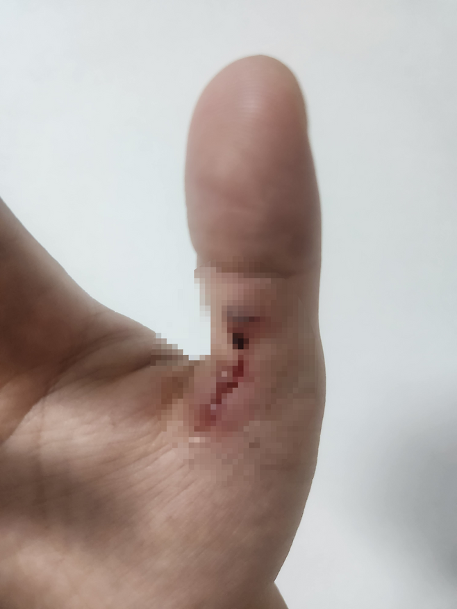 사고로 다친 A소방장의 손. A소방장 제공