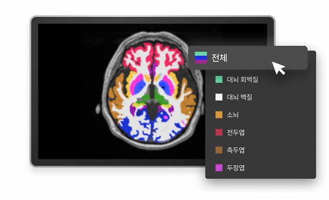 뇌 질환 진단·치료 인공지능(AI) 기업 뉴로핏이 기술특례로 코스닥 상장에 도전한다. 사진은 뉴로핏 제품 뇌 분석 영상 이미지./사진=뉴로핏