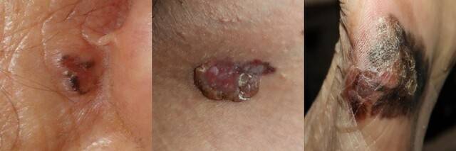 기저세포암(왼쪽부터 , 편평세포암, 악성흑색종. 서울대병원