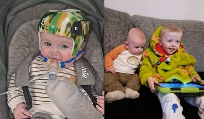 두개골 변형을 막기 위해 하루 23시간 헬멧을 써야 하는 생후 7개월 아기의 사연이 소개됐다. [사진=SNS]