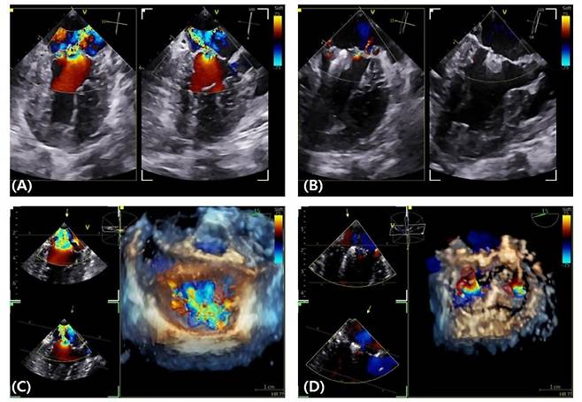 수술 중 클램프 장착 전, 후의 이첨판 역류 정도를 평가한 영상. 클램프 장착 후 역류량이 두드러지게 감소한 것을 확인할 수 있다(고려동물메디컬센터 제공) ⓒ 뉴스1