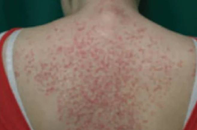 ‘케토래쉬’ 증상. 케톤산증으로 인한 ‘색소성 양진’이 나타난 모습. [Regendary Food]