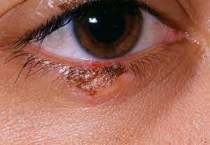 물놀이 후 눈이 가렵고 염증이 생겼다면 헤르페스 바이러스 감염이 원인일 수 있다./클립아트코리아