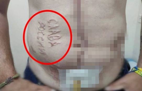 9일(현지시간) 러시아에 억류돼 있다 우크라이나로 돌아온 포로의 몸에서 ‘러시아에 영광을’ 이라고 적힌 흉터가 확인됐다. 우크라이나 국방정보국 제공